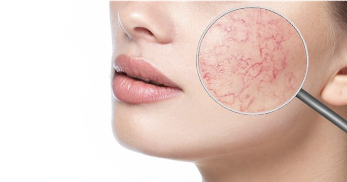 17 ноября, с 11:00- 15-00 Семинар "Комбинация Arkana и Capri Beauty Line  в работе с розацеа"