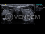 Аппарат УЗИ (сканер) Siemens Healthineers Acuson S3000
