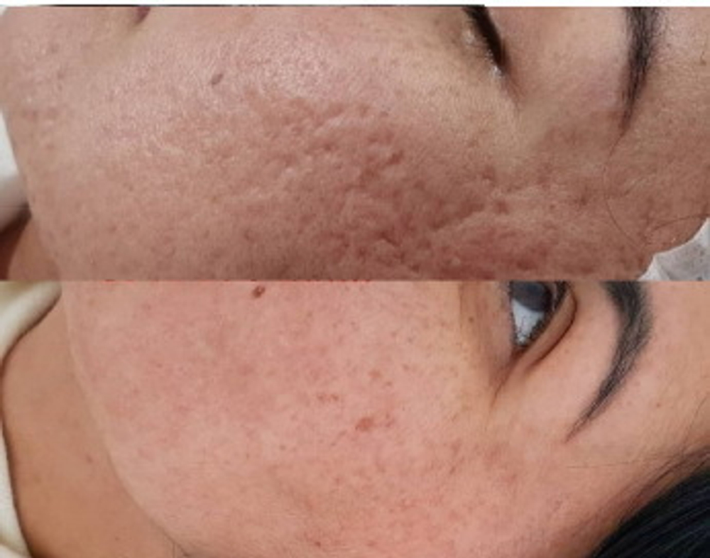 PDRN Booster Eldermafill | Усилитель мезотерапии