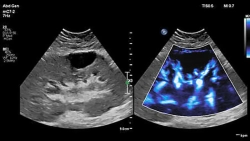 Аппарат УЗИ Philips EPIQ Elite