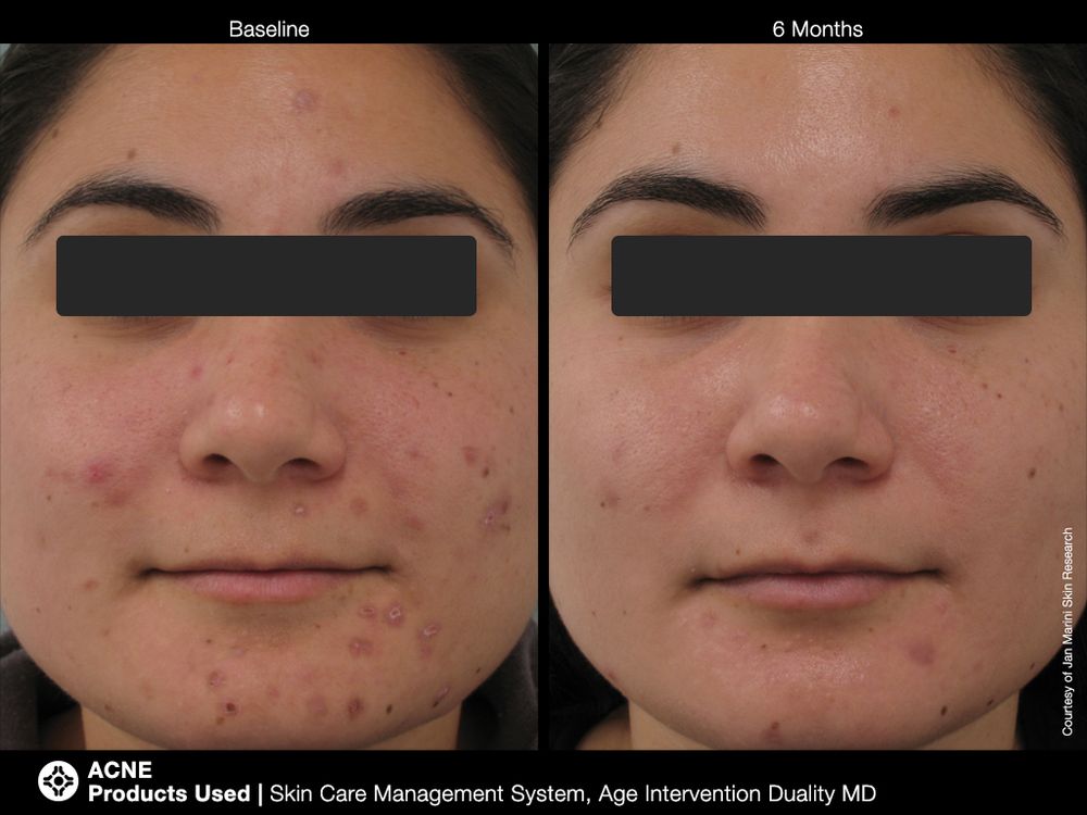 JAN MARINI AGE INTERVENTION DUALITY MD 0,9 % Крем-акселератор с ретинолом 0,9% для решения проблем возрастного акне