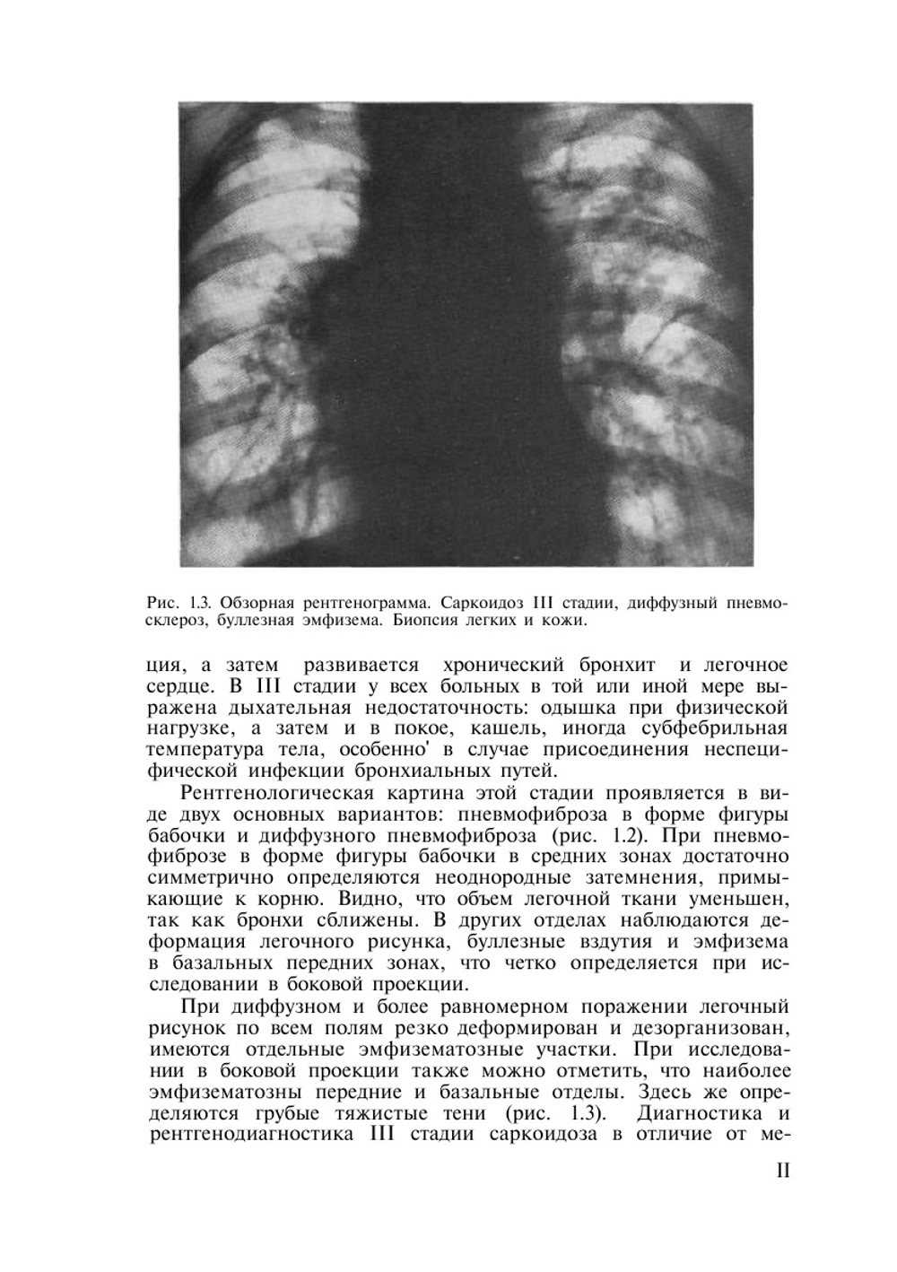 Дифференциальная рентгенодиагностика заболеваний органов дыхания и средостения. Том 2 | Л.С. Розенштраух; М.Г. Виннер