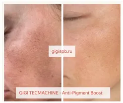 Бустер для осветления пигментации