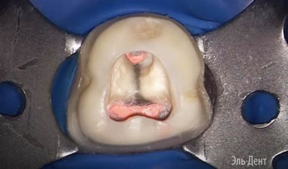 АШ Плюс (AH Plus)- двухкомпонентная паста для пломбирования каналов, Dentsply (4 мл+ 4 мл )