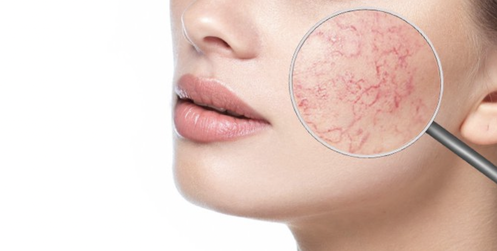 17 ноября, с 11:00 до 15-00 Комбинация Arkana и Capri Beauty Line в работе с розацеа Семинар: "Комбинация новых многофункциональных молекул космецевтики ARKANA при работе с розацеа. Сочетанные протоколы с Capri Beauty Line на этапе ремиссии."