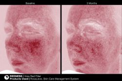 JAN MARINI ROSALIEVE Крем-акселератор для комплексного решения проблем розацеа
