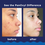 PanOxyl, Пенка для умывания от акне, для лица и тела, максимальная сила действия, 28 г (1 унция)