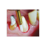 EDENTA STT249.314.016 Хирургический тканевый триммер для операции на мягких тканях полости рта STT249 FG, d 1,6 мм