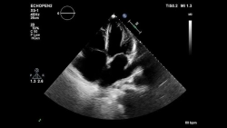 Аппарат УЗИ Philips Epiq 7