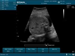 Аппарат УЗИ Edan DUS 60 (стандартный)