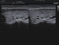 Аппарат УЗИ (сканер) Samsung Medison HS30