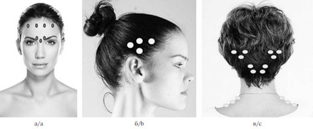 Ботулинотерапия мигрени (головной боли)