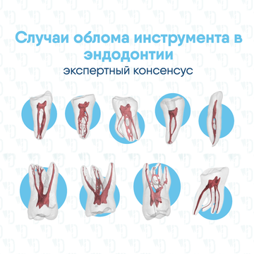 Экспертный консенсус по ведению случаев облома инструмента в эндодонтической практике