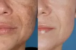 Веганский пилинг-тоник с 7% гликолевой кислоты The Ordinary Glycolic Acid 7% Exfoliating Toner 240 мл.