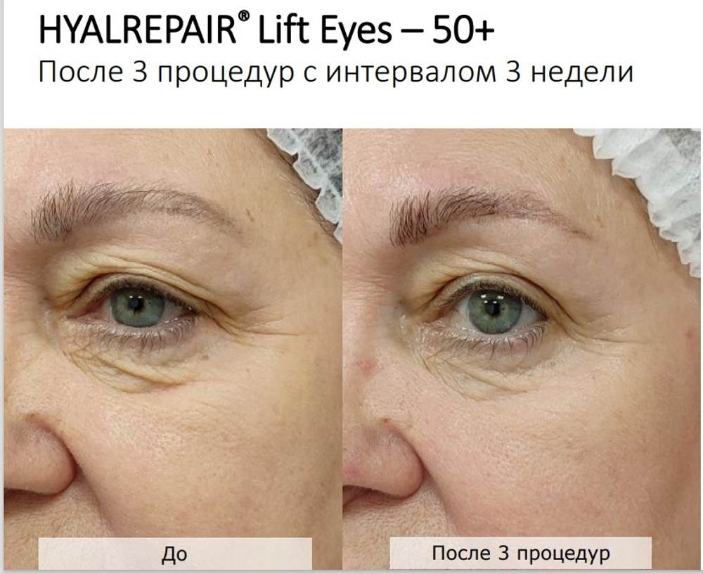 Hyalrepair Lift Eyes | ГК 12 мг/мл + Вит.С и Аминокислоты