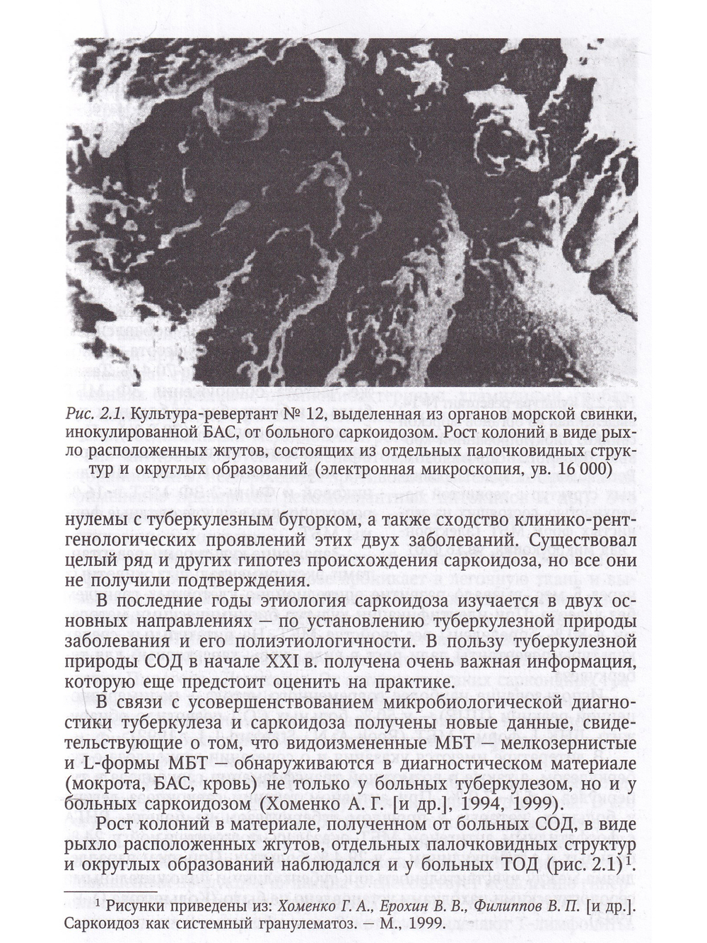 Саркоидоз в клинике туберкулеза органов дыхания
