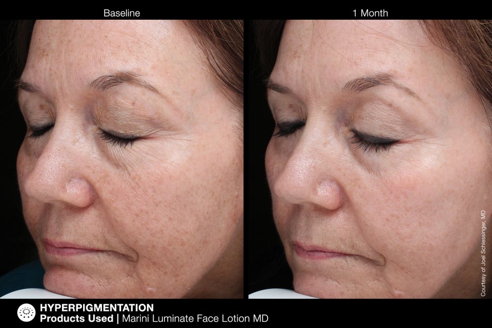 JAN MARINI LUMINATE FACE LOTION MD, 0,75% Крем-акселератор с ретинолом 0,75% для борьбы с пигментацией