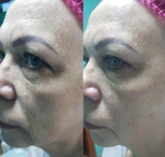 3G In-Volume Ampoule Eldermafill | Биореструктуризант