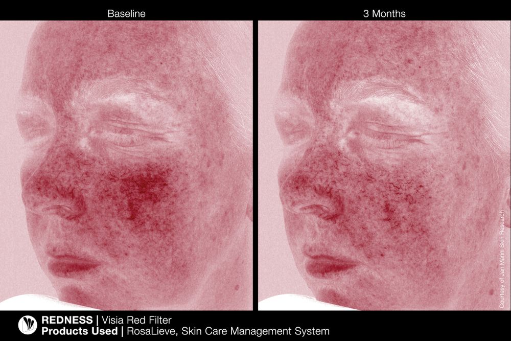 JAN MARINI ROSALIEVE Крем-акселератор для комплексного решения проблем розацеа