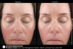 JAN MARINI LUMINATE FACE LOTION MD, 0,75% Крем-акселератор с ретинолом 0,75% для борьбы с пигментацией