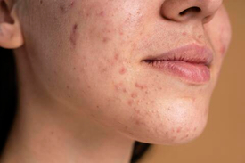 Acne and post-acne