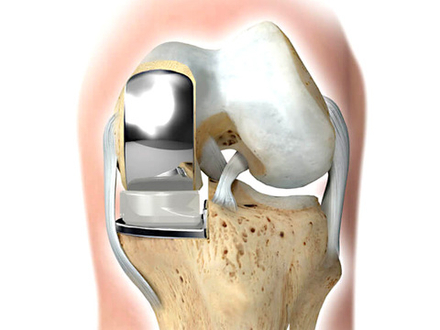 Частичное эндопротезирование коленного сустава