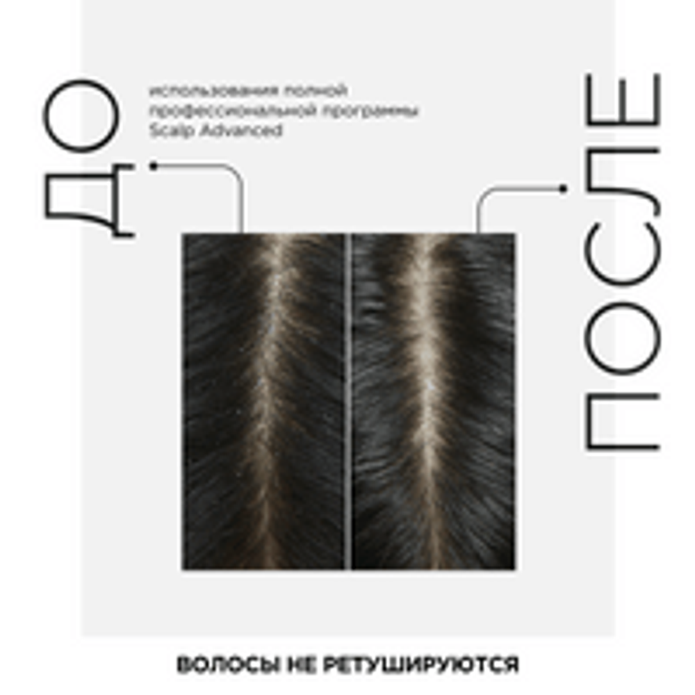 L'Oreal Professionnel Scalp Advanced шампунь против перхоти для всех типов волос, 300 мл .