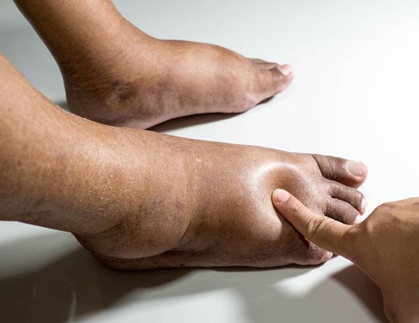 Поражение почек – опасность, которую можно избежать