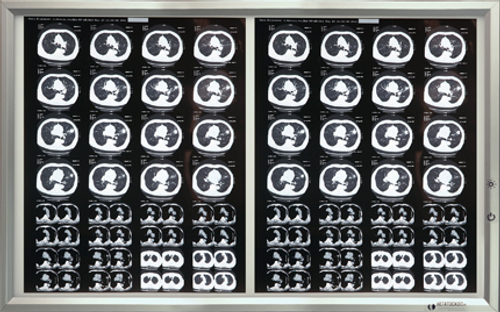 Негатоскоп на 2 снимка медицинский светодиодный