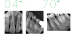 Портативный рентген Genoray Port-X IV