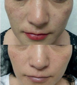 PDRN Glutathione Ampoule Eldermafill | Сияние и реструктуризация