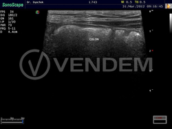 Аппарат УЗИ (сканер) Sonoscape S15