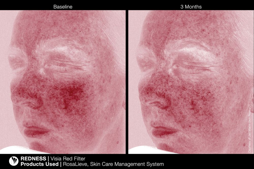 JAN MARINI ROSALIEVE Крем-акселератор для комплексного решения проблем розацеа