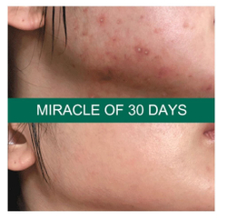 Some By Mi AHA-BHA-PHA 30 Days Miracle Starter Edition набор для проблемной кожи с кислотами из 4 средств
