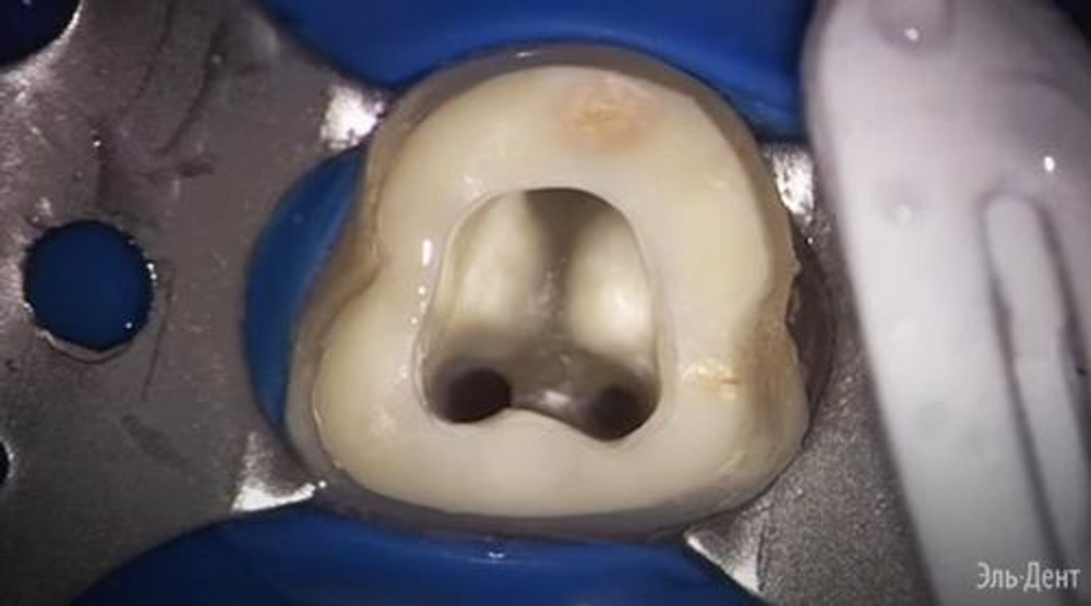 АШ Плюс (AH Plus)- двухкомпонентная паста для пломбирования каналов, Dentsply (4 мл+ 4 мл )