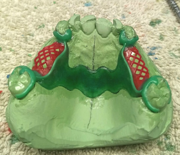 Крепление бюгельного протеза к опорным зубам Крепление бюгельного протеза к опорным зубам