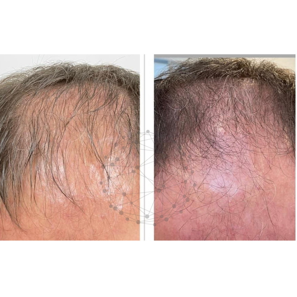 ASCE+ HRLV ExoCoBio | Лиофилизированный порошок экзосом для восстановления кожи головы и волос