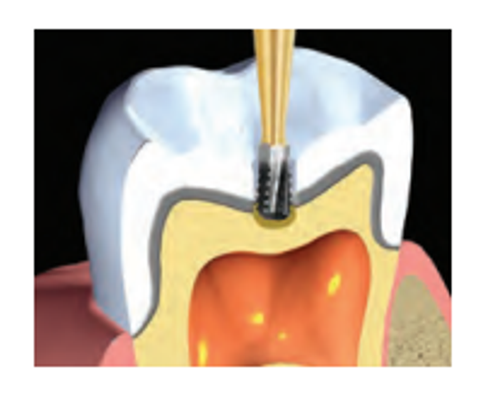 Бор твердосплавный Midwest - 166 FGSS 245