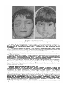 Офтальмологические симптомы при болезнях ЛОР-органов и полости рта | М.М. Золотарева