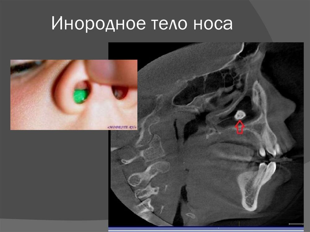 Модель носа (носоглотки) в разрезе — купить по ФГОС | Учебный стандарт