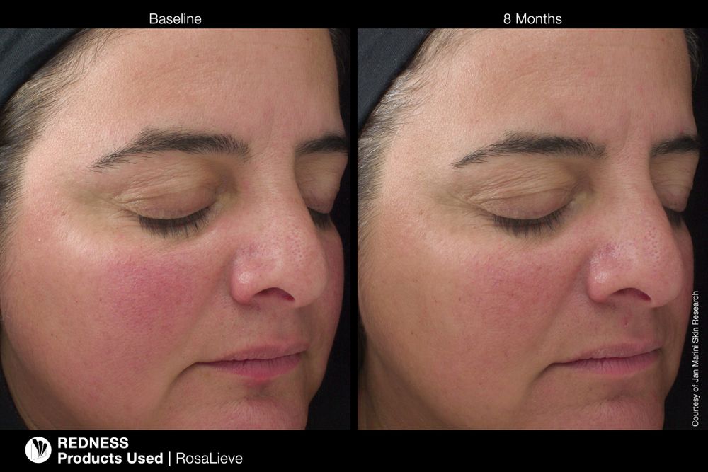 JAN MARINI ROSALIEVE Крем-акселератор для комплексного решения проблем розацеа