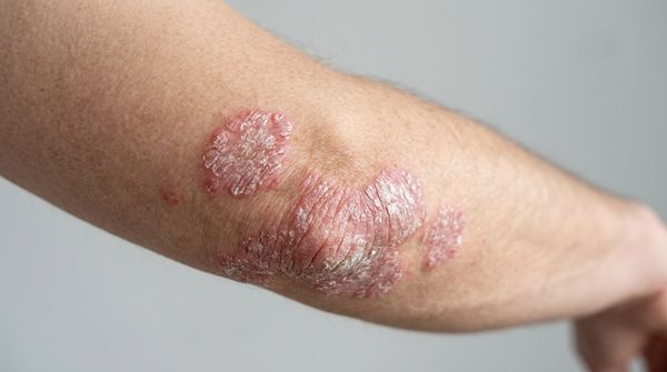 Псориаз: бұл не, қалай көрінеді және теріні қалай күту керек