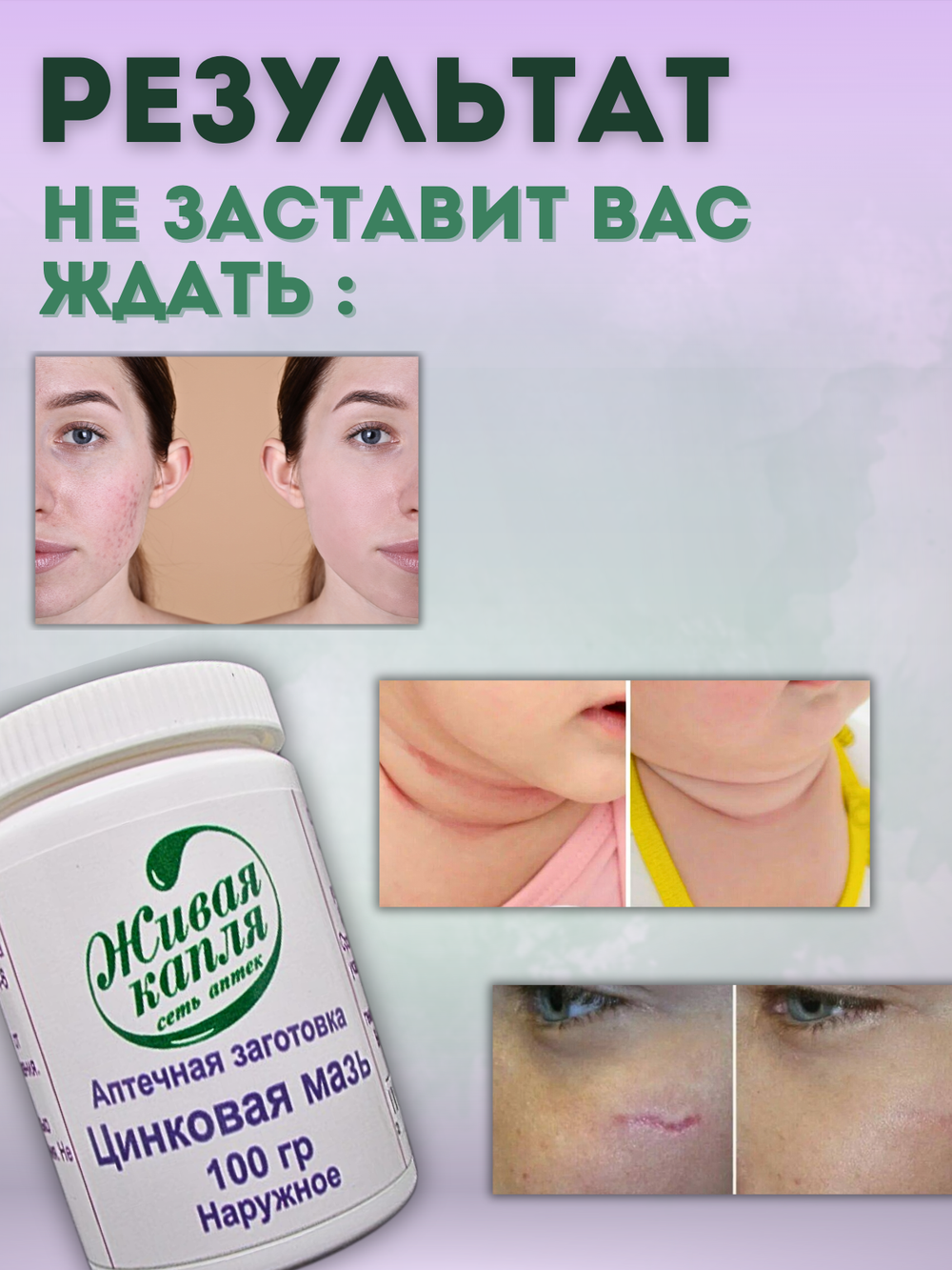 ЦИНКОВАЯ МАЗЬ 10% 100 г