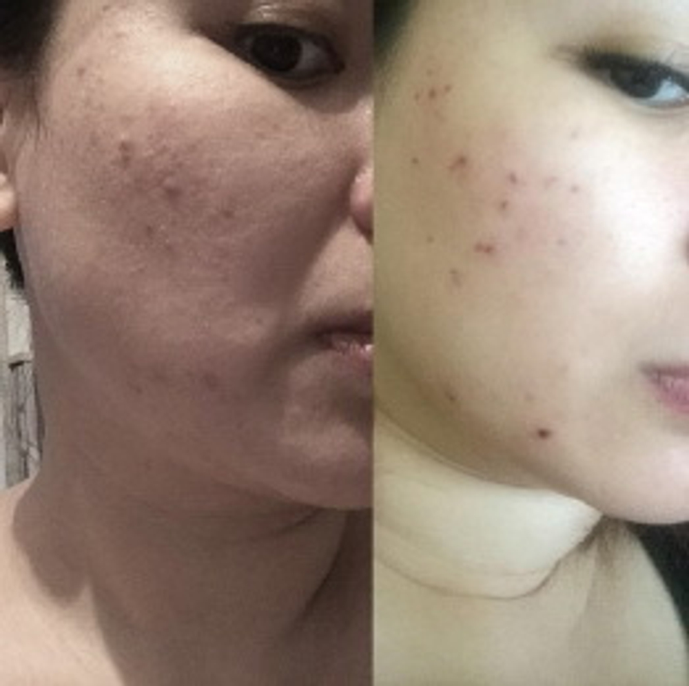 In-AC Ampoule Eldermafill | Терапия акне