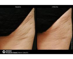 JAN MARINI CELLULITX Высокоэффективный антицеллюлитный крем