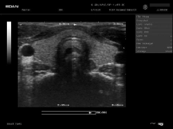 Аппарат УЗИ Edan DUS 60 (для гинекологии, стандартный)