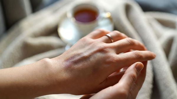 Синяки на теле без причины: сигнал тревоги от ваших сосудов Синяки на теле без причины: сигнал тревоги от ваших сосудов