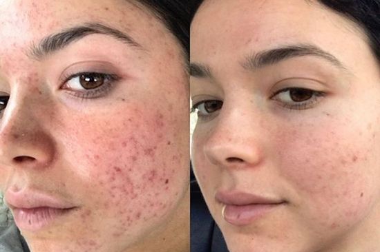 Что поможет в борьбе с  пигментацией и постакне.