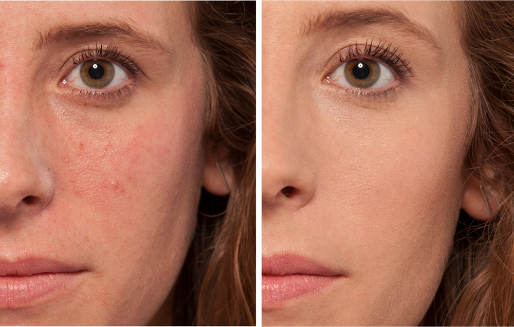 L’Oreal Paris True Match The One - Корректор в жидкости оттенок 1.R/C Rose Ivory, 6 ml