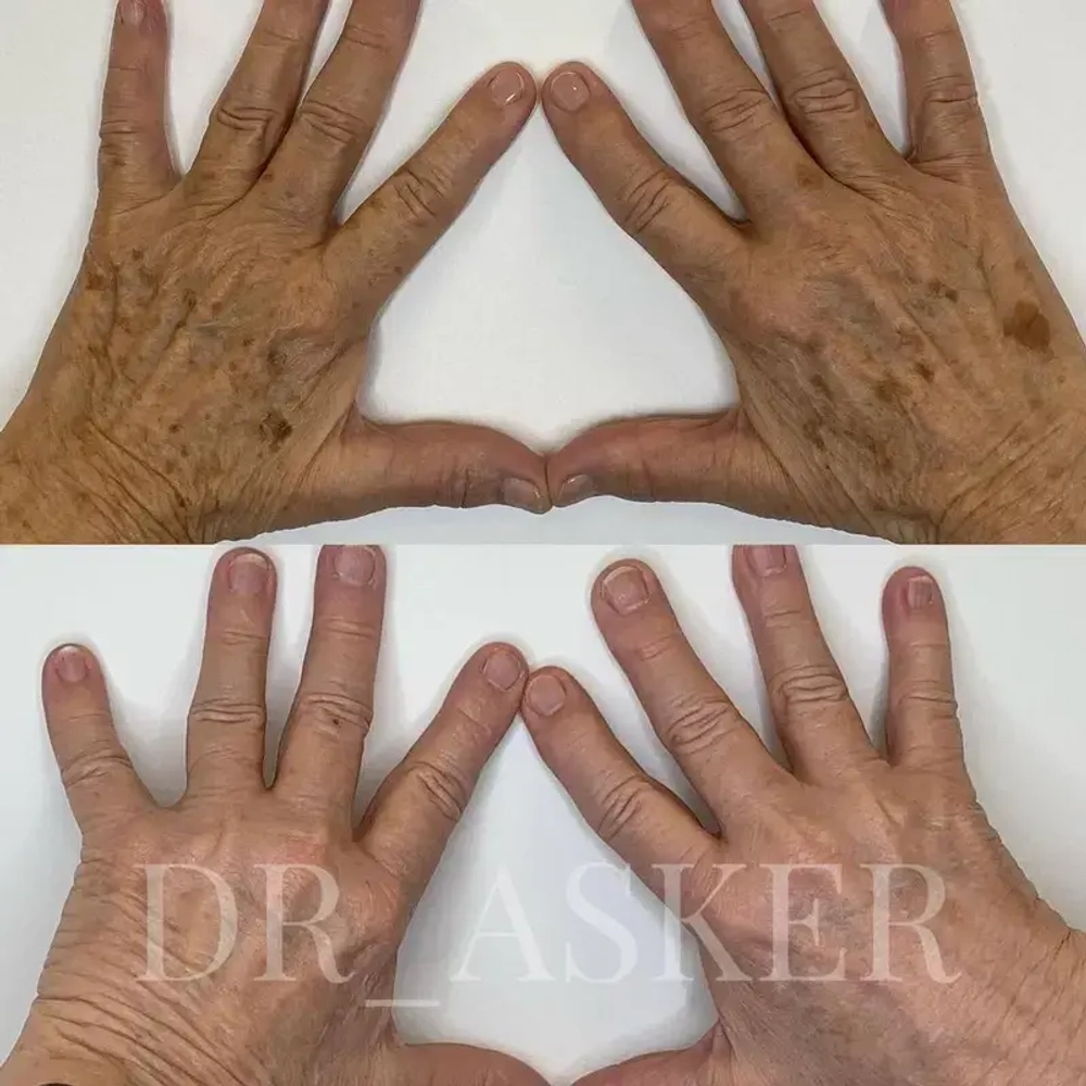 Collagen+ Akvavita | Рекомбинантный коллаген III типа